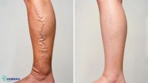 فرق واریس و رگ عنکبوتی